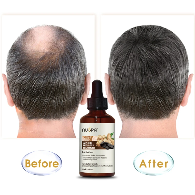 Ginger Anti Hair Loss Growth Hair Oil